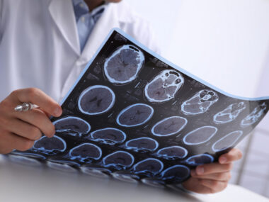 A doctor examines imaging scans of the brain.