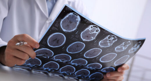 A doctor examines imaging scans of the brain.